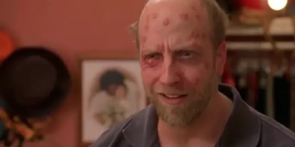   ドムのクローズアップ's face in Something About Mary with hives